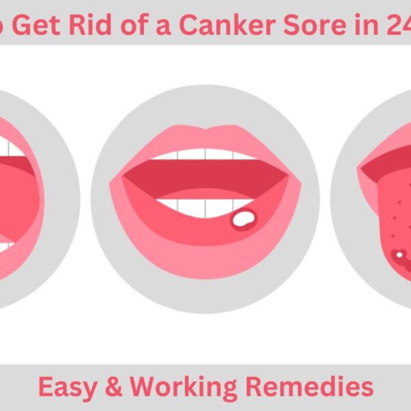 How To Get Rid of a Canker Sore in 24 Hours
