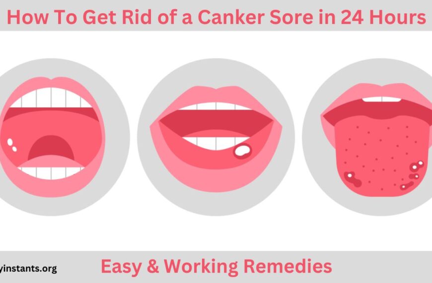 How To Get Rid of a Canker Sore in 24 Hours Easily